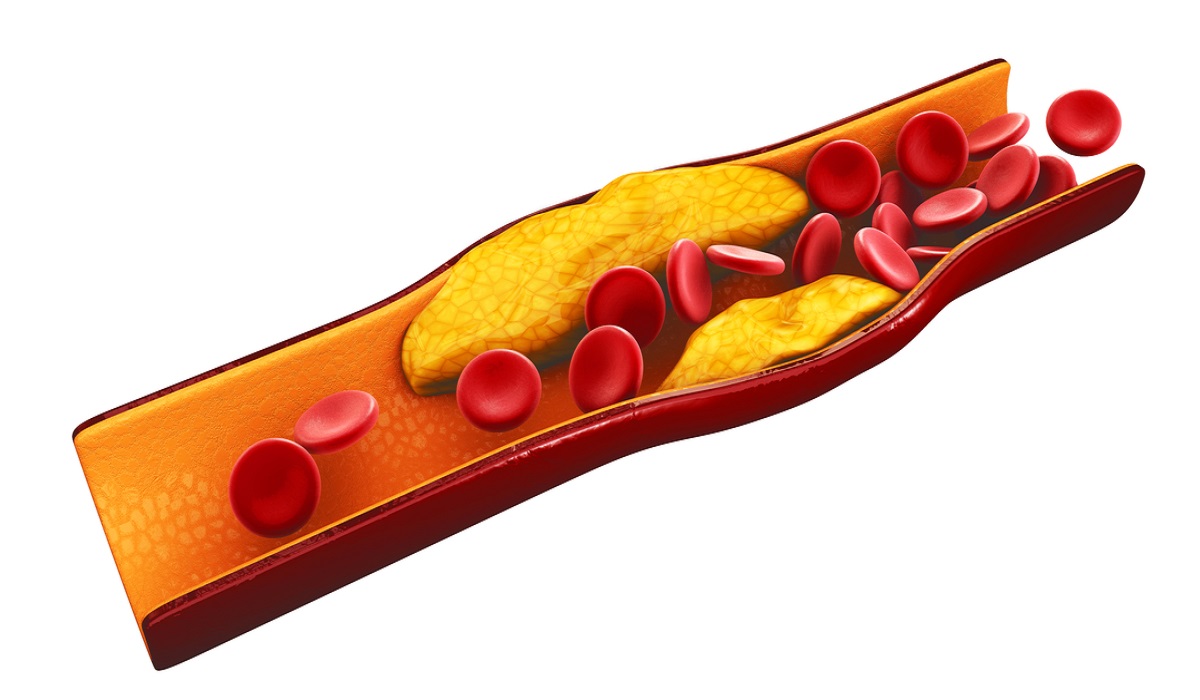 ارتفاع الكوليسترول