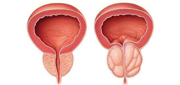 ما الفرق بين تضخم البروستاتا الحميد والخبيث